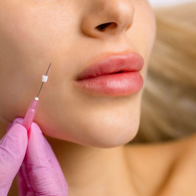 PDO threads for non-surgical facial lifting